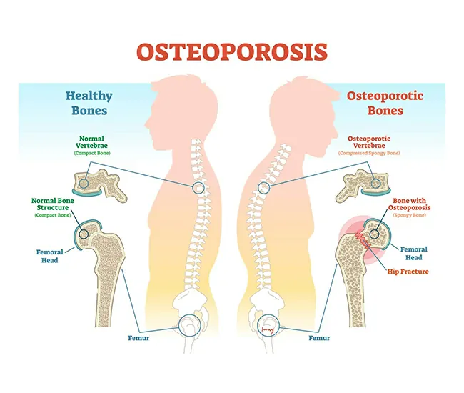 Symptoms of Osteoporosis & Calcium Deficiency