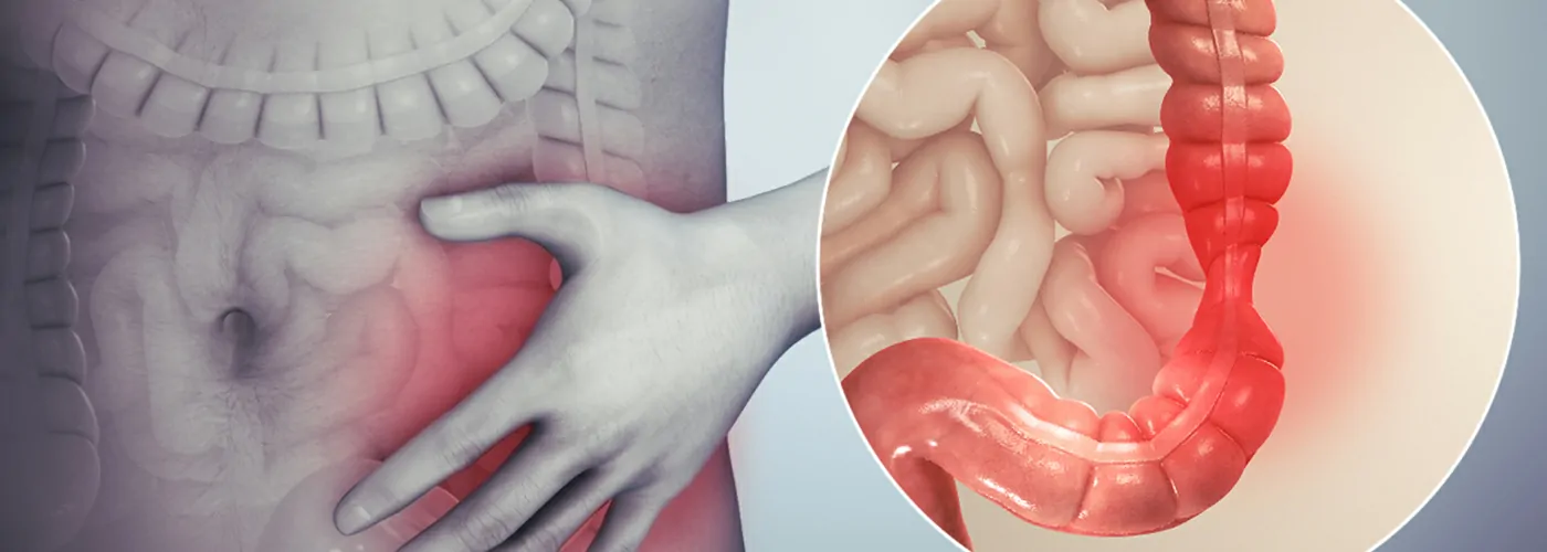 Irritable Bowel Syndrome (IBS) & Inflammatory Bowel Disease (IBD) – Causes, Symptoms & Treatment