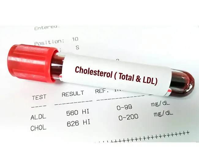 Symptoms of High Cholesterol