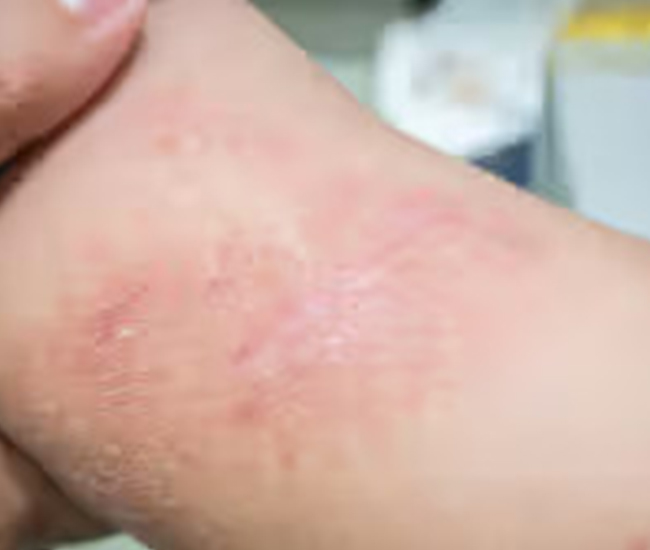 Symptoms of Allergic Dermatitis