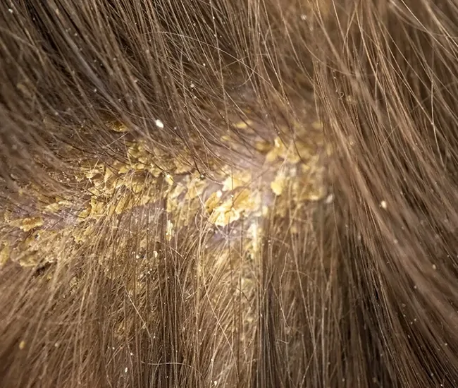 Causes of Dandruff & Folliculitis