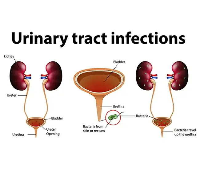 What is a Urinary Tract Infection (UTI)?