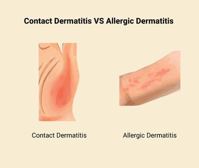 Causes & Triggers of Allergic Dermatitis