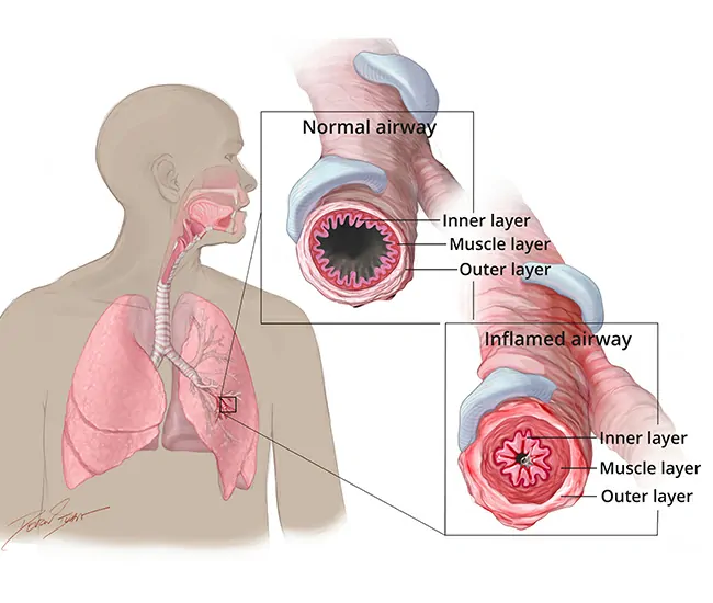 What is Asthma & Bronchitis?