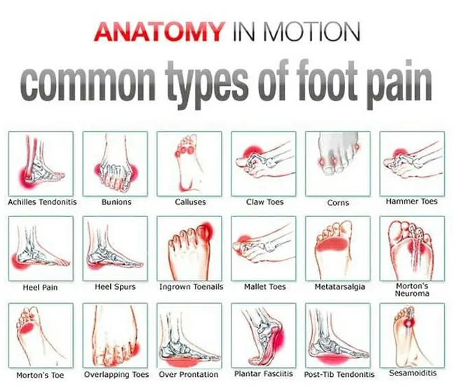 What is Foot Pain, Calcaneal Spur & Plantar Fasciitis?