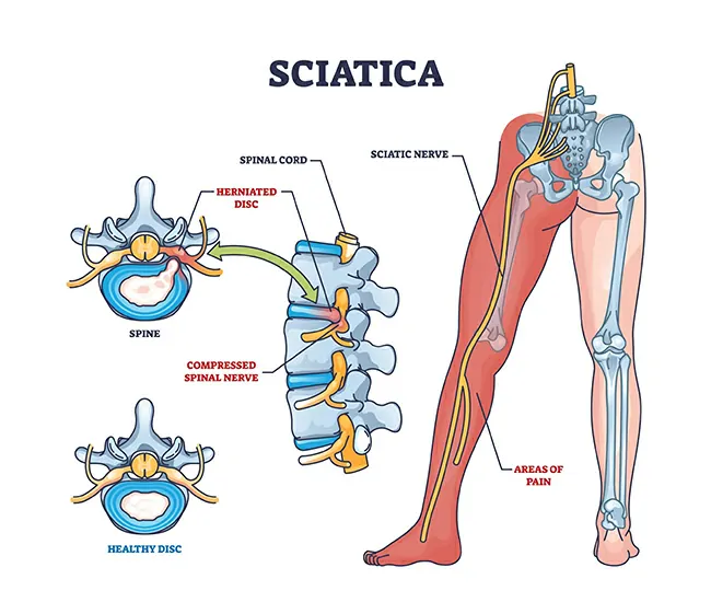 What is Sciatica?