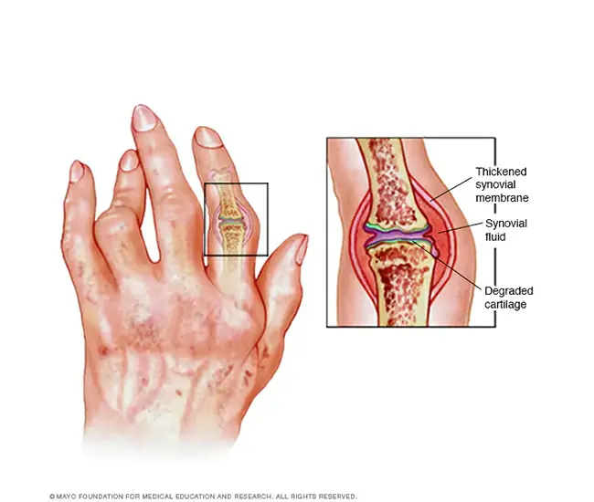 Causes of Rheumatoid Arthritis