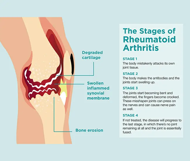 Symptoms of Rheumatoid Arthritis