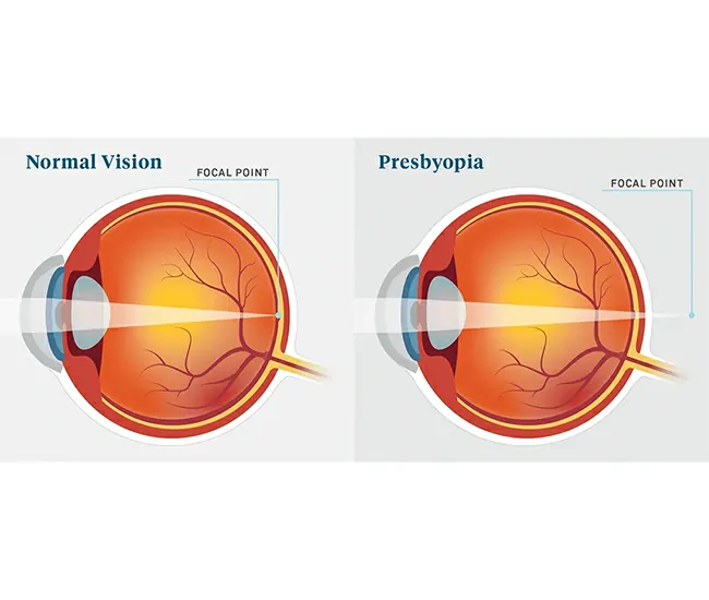 Myopia – Causes and Symptoms