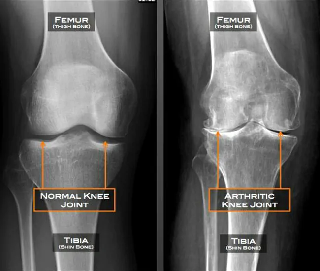 What is Knee Osteoarthritis?