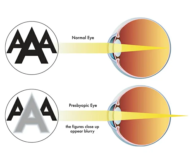 Presbyopia – Causes and Symptoms